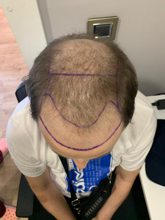 Hair Loss in Men: Causes, Treatments, and Prevention